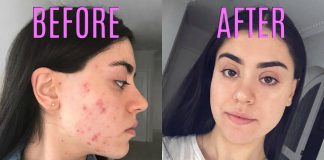 GET RID OF HORMONAL ACNE NATURALLY